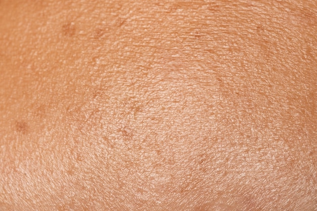 Close-up huidtextuur met sproeten