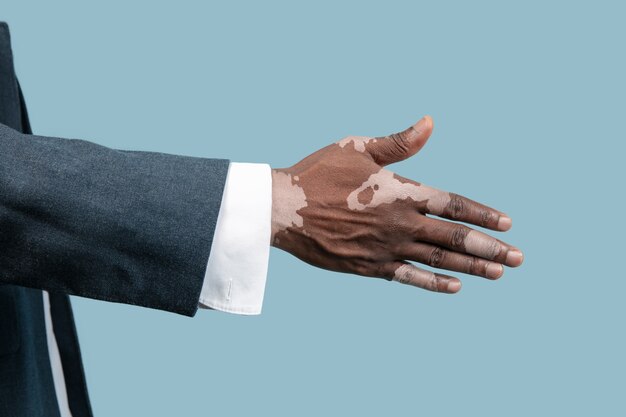 Close up van mannelijke handen met vitiligo pigmenten geïsoleerd op blauwe achtergrond. Speciale huid