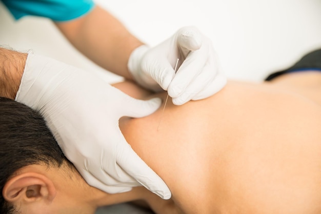 Close-up van shirtloze man die dry needling-therapie krijgt van de arts in de kliniek