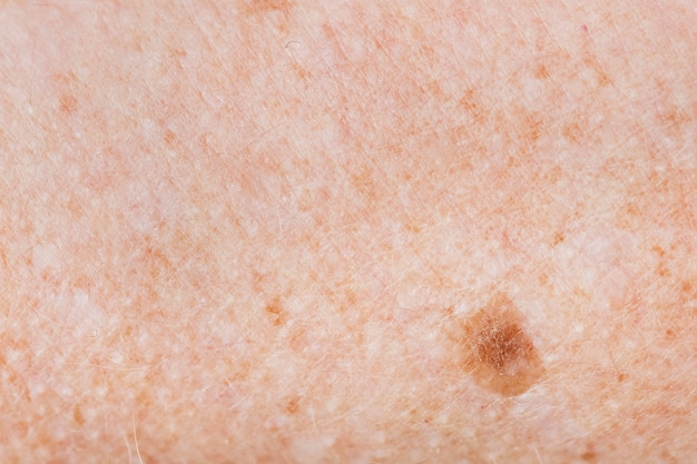 Close-up van sproeten huid
