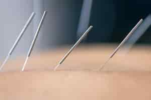 Gratis foto dry needling acupunctuurnaalden op patiënt close-up