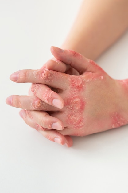 Gratis foto handen van patiënt die aan psoriasis lijdt