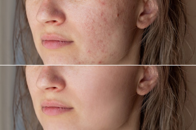 Het gezicht van een jonge vrouw voor en na acnebehandeling op het gezicht puistjes rode littekens uitslag op de wangen