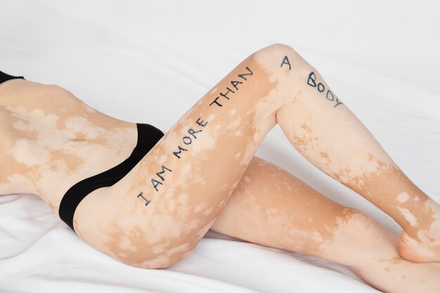 Mooie jonge vrouw met vitiligo