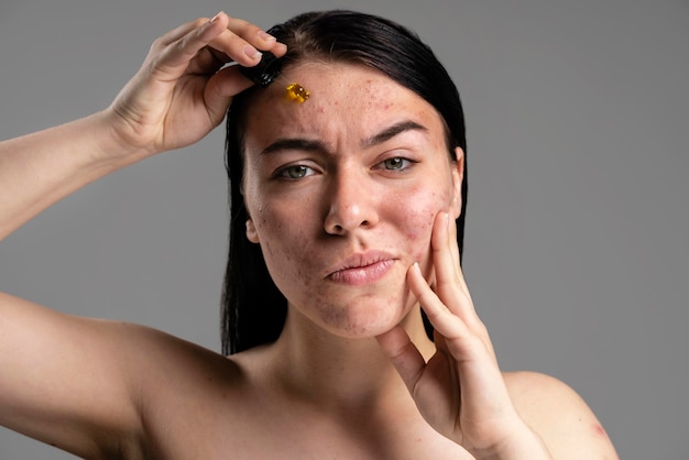 Mooie vrouw die haar acne met vertrouwen toont