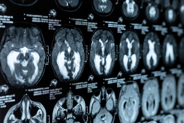 Mri-scan of magnetische resonantiebeeld van de hersenen toonde obstructieve triventriculaire hydrocephalus. medisch dienstverleningsconcept.