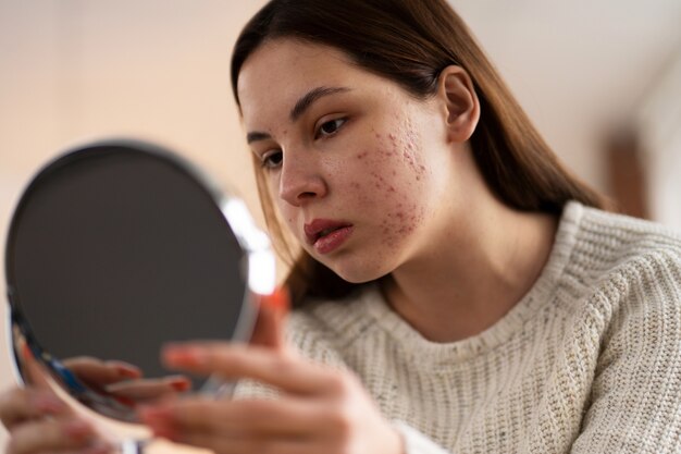 Persoon die te maken heeft met rosacea