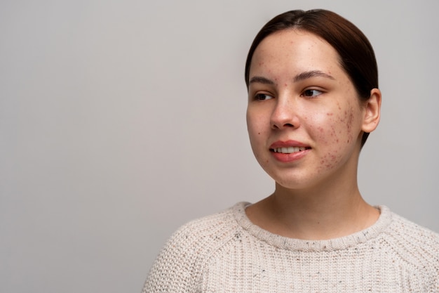 Persoon die te maken heeft met rosacea