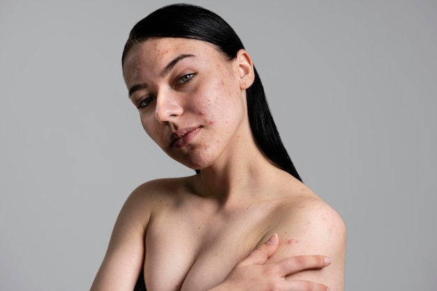 Portret van mooie jonge vrouw met acne
