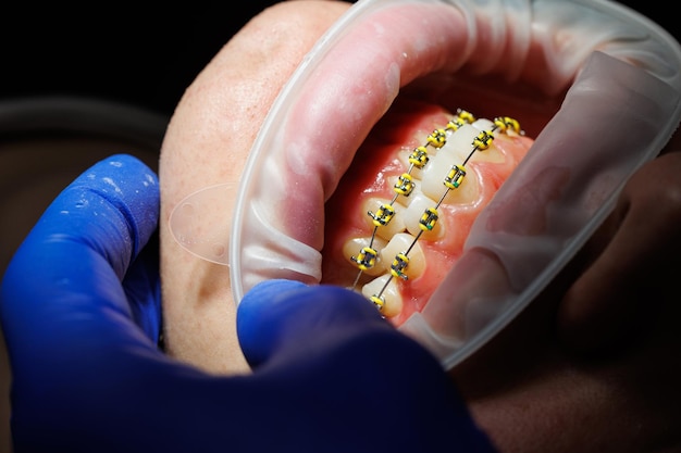 Verlenger voor tanden. tanden van een vrouw met beugels bij een tandartsafspraak. orthodontische behandeling van tandvervorming. close-up, selectieve aandacht. beugels op tanden