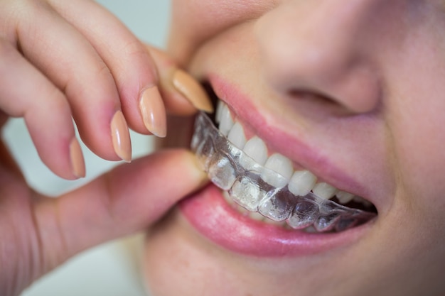 Vrouw die orthodontische onzichtbare steunen van silicone draagt