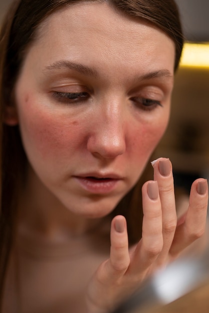 Vrouw die vochtinbrengende crème gebruikt om te helpen bij de huidaandoening van rosacea