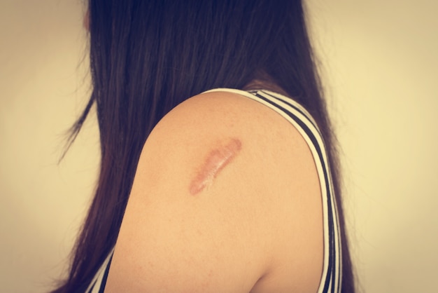 Vrouw met een litteken op haar arm
