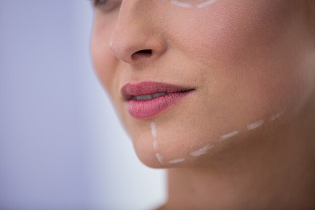 Vrouw met merken getekend voor cosmetische behandeling op haar kaak