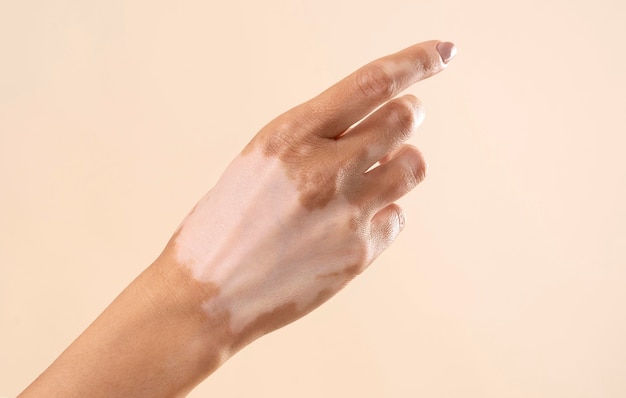 Vrouw toont haar vitiligo huiddelen