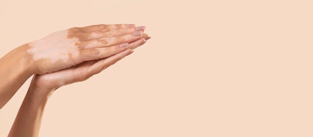 Vrouw toont haar vitiligo huiddelen