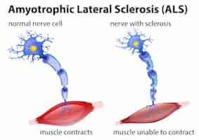 Gratis vector amyotrofisch lateraal scleroseconcept