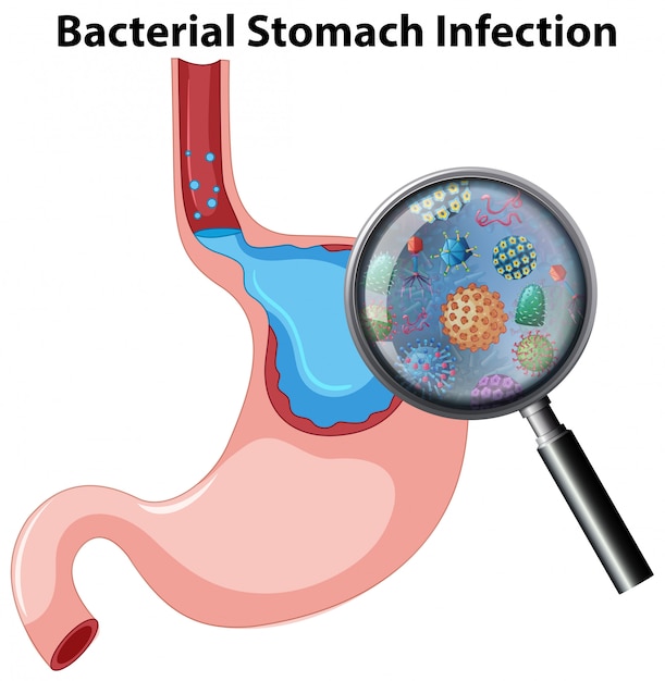 Gratis vector anatomie bacteriële maag-infectie