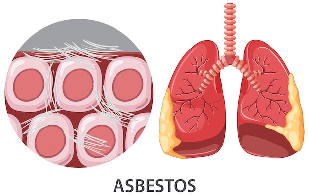 Gratis vector asbestose op menselijke longen