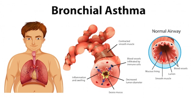 Gratis vector astma ontstoken bronchiën