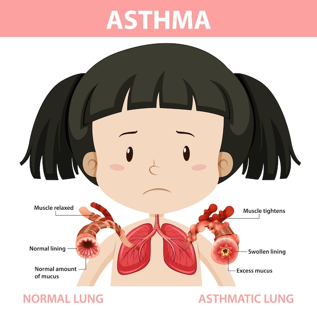 Astmadiagram met normale long en astmatische long