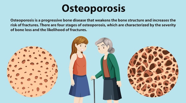 Gratis vector botdichtheid en osteoporose vector