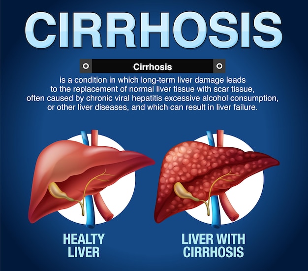 Cirrose van de lever infographic