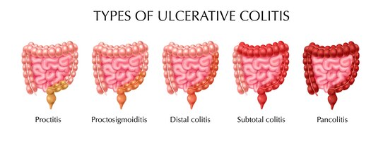 Colitis ulcerosa typen infographics
