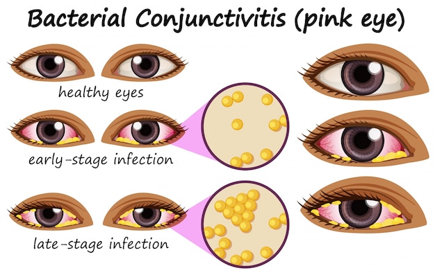 Gratis vector diagram dat bacteriële conjunctivitis in het menselijk oog toont