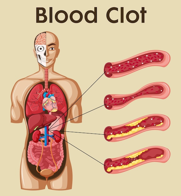 Diagram met bloedstolsel bij mensen