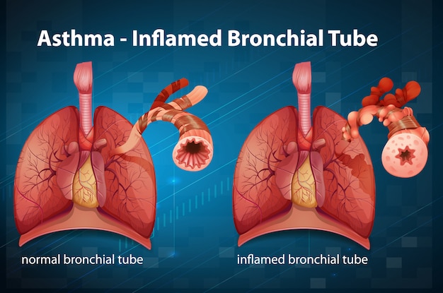 Diagram met door astma ontstoken bronchiën bij de mens