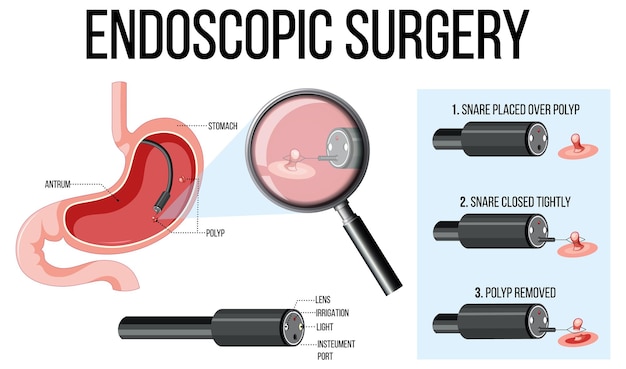 Gratis vector diagram met endoscopische chirurgie