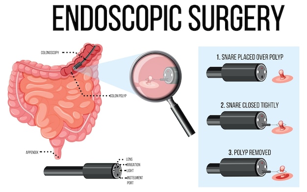 Gratis vector diagram met endoscopische chirurgie