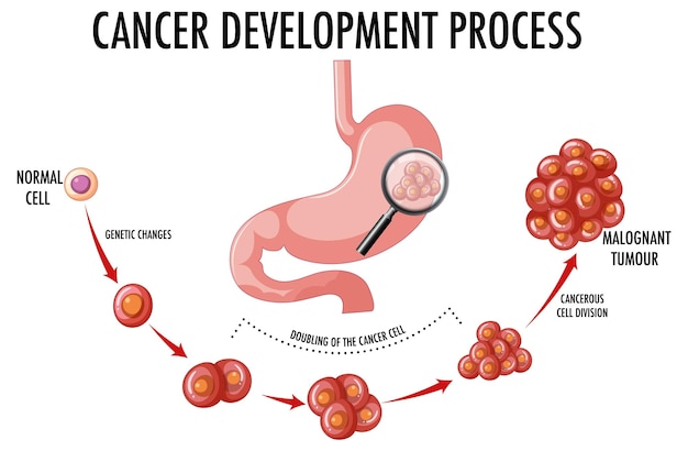 Gratis vector diagram met het ontwikkelingsproces van kanker