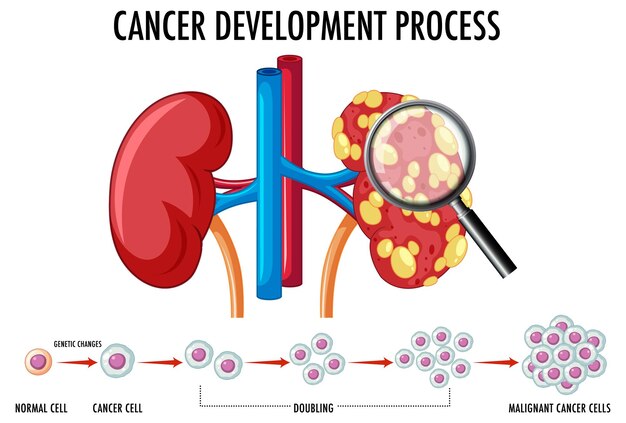 Diagram met het ontwikkelingsproces van kanker