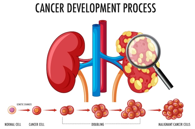 Diagram met het ontwikkelingsproces van kanker