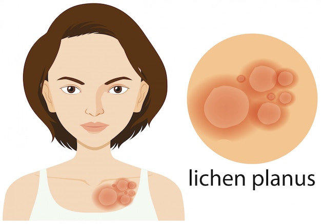 Diagram met lichen planus op de huid van de vrouw