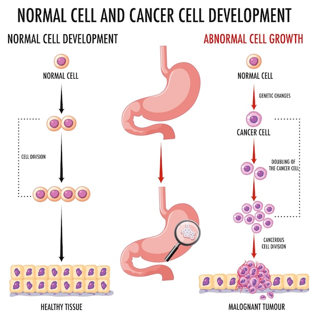 Gratis vector diagram met normale en kankercellen bij mensen