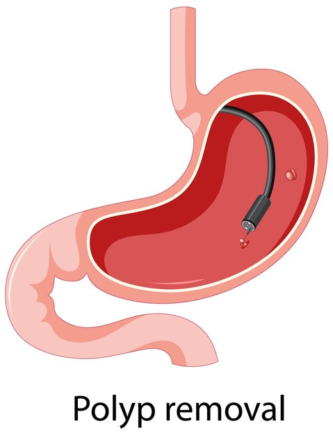 Diagram met verwijdering van poliepen bij mensen
