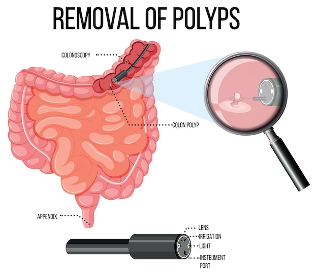 Diagram met verwijdering van poliepen