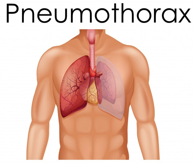 Een menselijke anatomie van pneumothorax