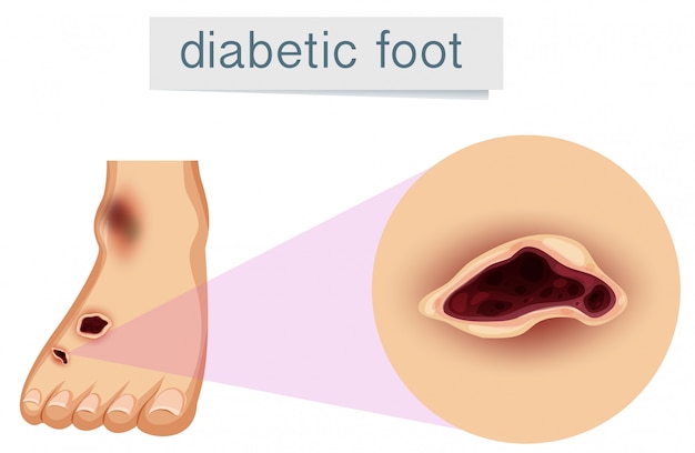 Gratis vector een menselijke voet met diabetes