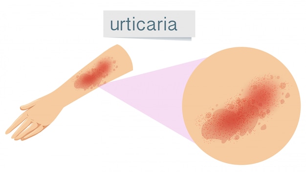 Gratis vector een urticaria voor de menselijke huid