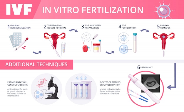 Gekleurde in-vitrofertilisatie ivf platte infographics met stappen van aanvullende technieken