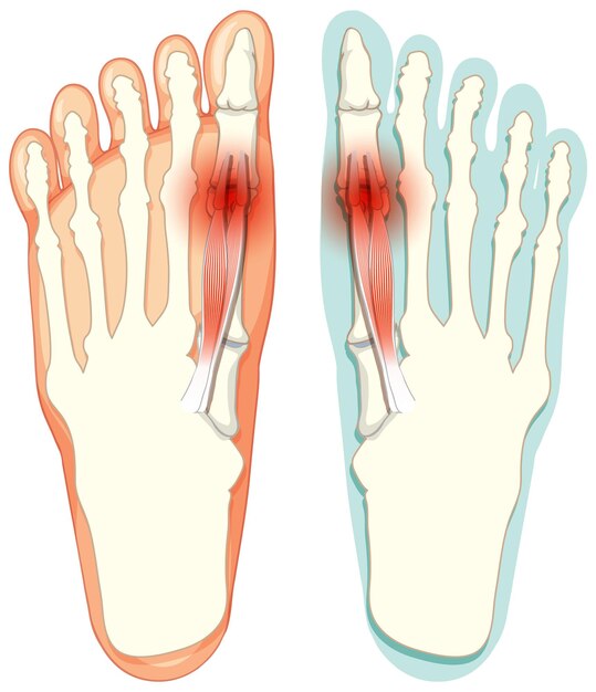 Hallux valgus typen op witte achtergrond