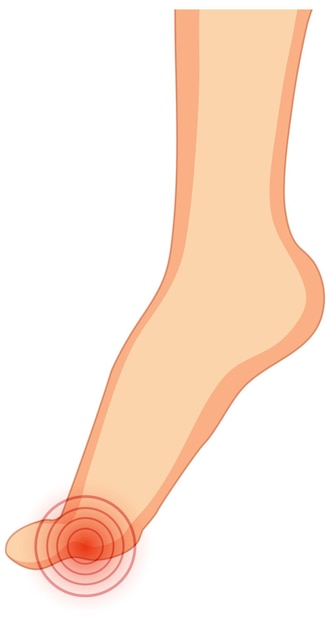 Gratis vector hallux valgus typen op witte achtergrond