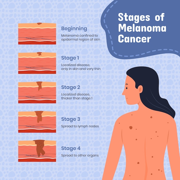 Gratis vector hand getekend plat ontwerp melanoom infographic