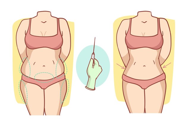 Hand getekende platte ontwerp liposuctie illustratie