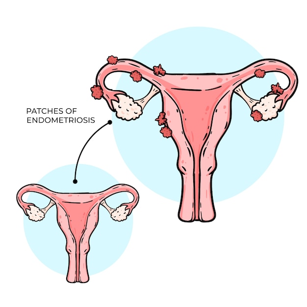 Handgetekende illustratie van endometriose