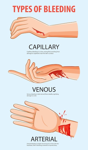 Gratis vector illustratie van een menselijke hand met verschillende soorten bloeding